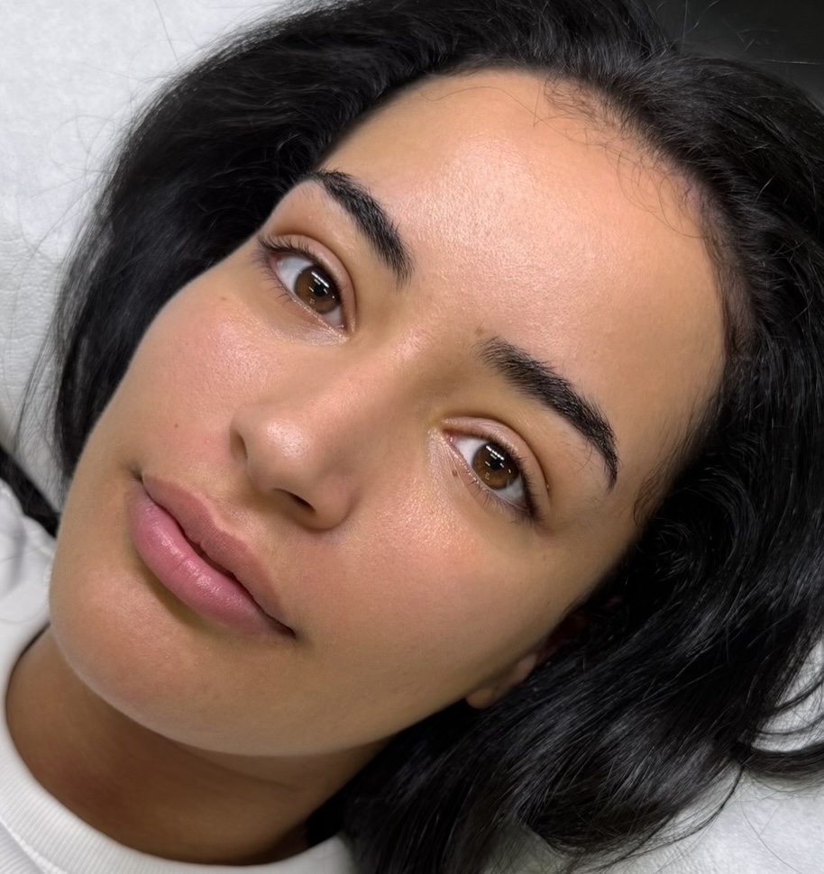 Brow Lift – Vorher