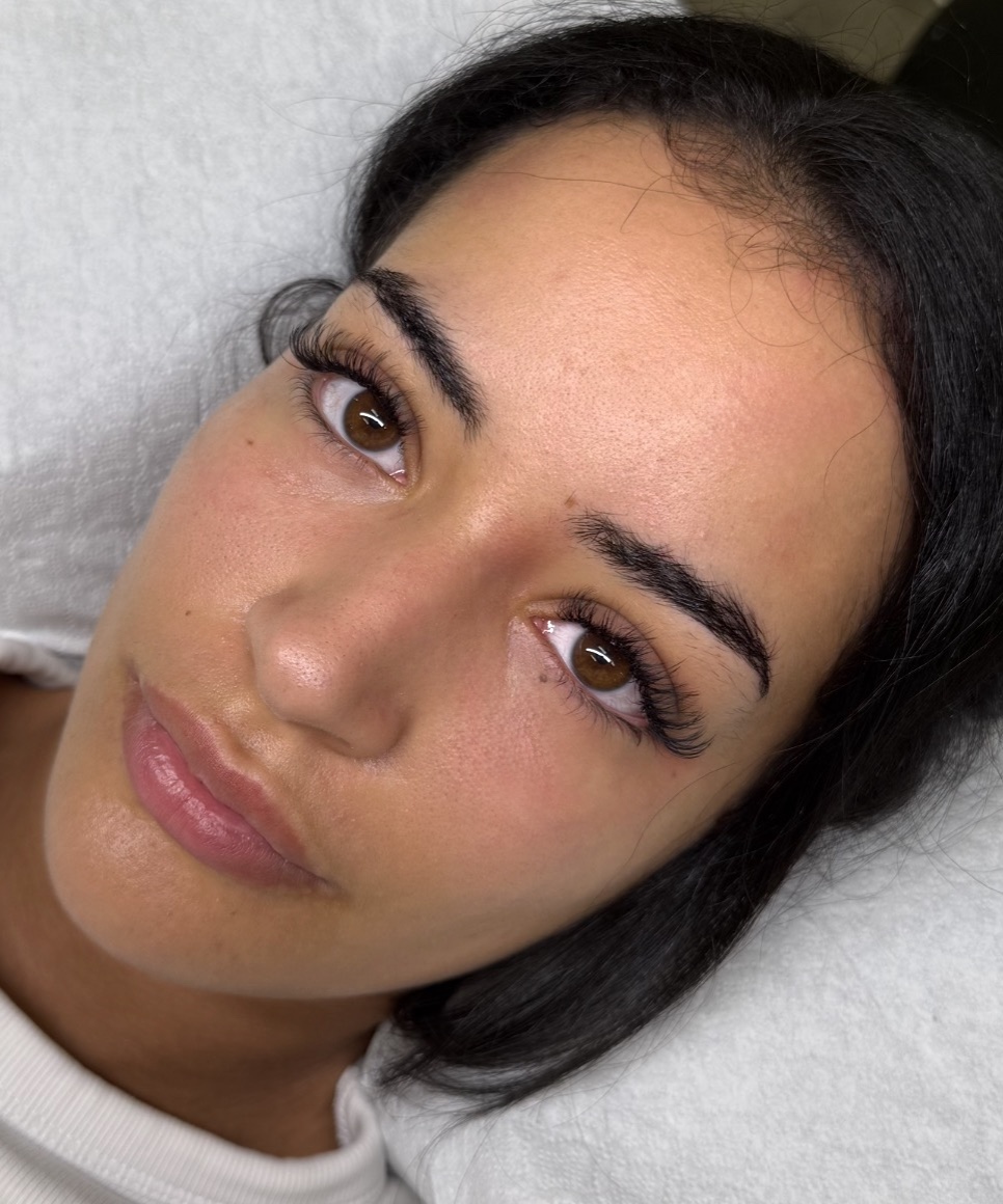 Brow Lift – Nachher
